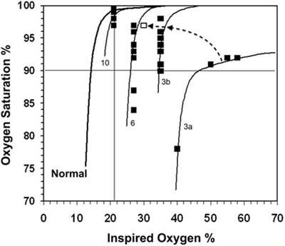 Unstable SpO2 in preterm infants: The key role of reduced ventilation to perfusion ratio